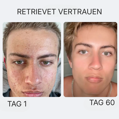 Reinigende Anti-Akne-Seife Nach Dem Sport